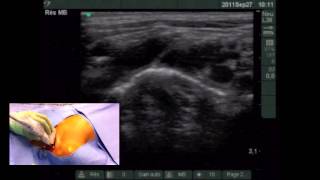 Ultrasoundguided supraclavicular subclavian vein catheterization In Children 1 [upl. by Edee]