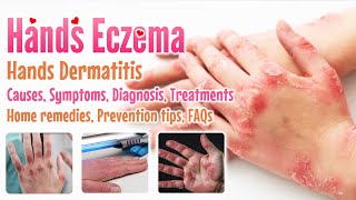 Eczema Hands overview causes sign and symptoms diagnosis treatment home remedies FAQs extend [upl. by Umeh]