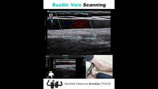 Basilic Vein Scanning  SonoEye [upl. by Asilet]