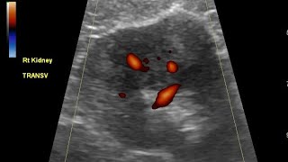 Echogenic renal mass renal cell carcinoma or Angiomyolipoma Ultrasound and color Doppler video [upl. by Nahtaj]