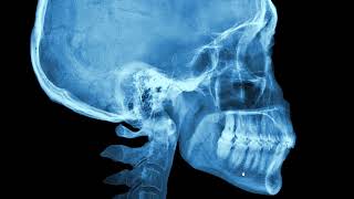 mandible and teethdental Xrays paranasal sinuses [upl. by Ronalda258]