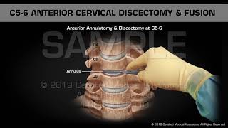 Anterior Cervical Discectomy amp Fusion at C56  Medical Animation [upl. by Letnohc]