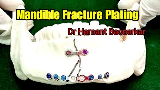 Mandible Fracture Plating [upl. by Haek]