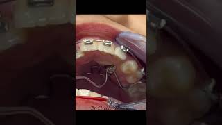 Gingiva removal above palatal impacted canine after successful closed orthodontic traction [upl. by Ilojna]