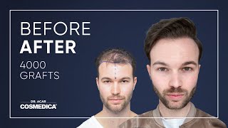 Hair Transplant in Turkey  Results  Dr Acar  Cosmedica Clinic [upl. by Llirpa]