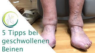 5 Tipps bei Geschwollenen Beinen [upl. by Yornek]