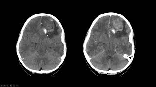 Oligodendroglioma [upl. by Tyree]