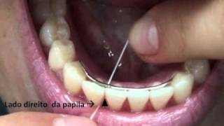 Como Passar Fio Dental no Dente com Aparelho  Orlando Tanaka [upl. by Kokoruda]