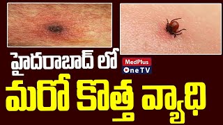 Scrub Typhus  New Disease in Hyderabad  MedPlusONETV [upl. by Leuamme748]