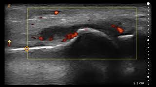 Image Interpretation 1st Metatarsophalangeal MTP [upl. by Ulrich748]