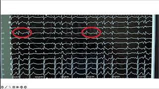 Mitral Annular Disjunction and Arrhythmias [upl. by Htyderem549]