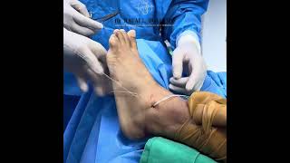 Combined Medial and Lateral Augmentation Ligament Reconstruction of the Ankle 100 PERCUTANEOUS [upl. by Metts]