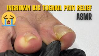 ingrown big toenail pain relief 😭  pedicure cleaning  pedicure asmr [upl. by Htor888]