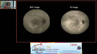 KSOS2023 Dr Anjana S FP134 Multimodal imaging biomarkers in eyes with Uveal effusion syndrome [upl. by Royd]