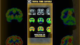 Why Is The Memento Movie PRAISED By Medical Professionals 😲 momento trivia medical [upl. by Eleda]