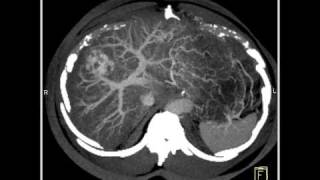 Abdomen LiverCT demonstrates a hemangioma of the liver because of the fatty infiltration10 of 10 [upl. by Annirak]