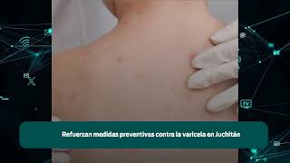 Refuerzan medidas preventivas contra la varicela en Juchitán [upl. by Anyehs70]