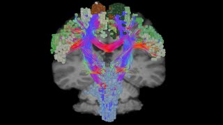 Part II  Informing Neurosurgical Disconnections with Connectomics [upl. by Kire]