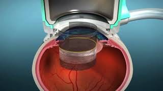 Capsulotomy  LenSx® Laser Cataract Surgery [upl. by Eiveneg]