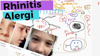 Rhinitis Alergi  Patofisiologi Diagnosis Tatalaksana [upl. by Ahsim215]