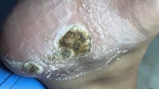 Removing dead Skin of large size Warts  Removing dead skin affected by Fungus on heel  pedicure [upl. by Race]