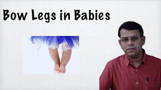 Bow legs in Babies [upl. by Yenalem]