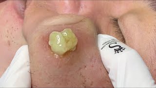 cystic acne blackhead whitehead removal  Relaxing Spa Acne Treatment [upl. by Sillig]