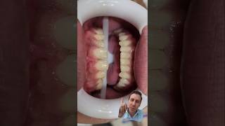 🔴ANTES E DEPOIS FACETAS CASO Extremo🙀diastemas conóides e ausência de laterais dentist [upl. by Anwadal]