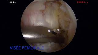 Ligamentoplastie du Ligament Croisé Antérieur LCA  Dr SIMIAN Périgueux [upl. by Remmos]