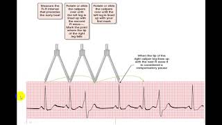 EKG EXTRASYSTOLES [upl. by Anivlem]