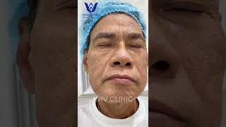 ĐIỀU TRỊ SẸO RỖ NẶNG TẠI PHÒNG KHÁM DA LIỄU HHV CLINIC [upl. by Annette]