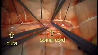 Dr Ali Bydon Performs A Spinal Cord AV Fistula Repair [upl. by Burtie]