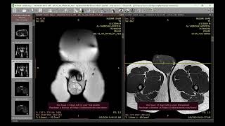 Non seminoma testicular tumor [upl. by Gorman]