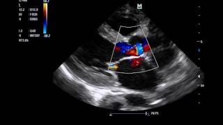 Lambls excrescences on transthoracic echocardiogram  Excrescências de Lambl no Eco Transtorácico [upl. by Aerdno]