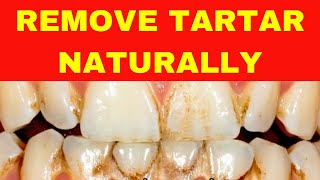 Say Goodbye to Tarter Easy Home Remedy For Dental Plaque TARTAR [upl. by Asiilanna]