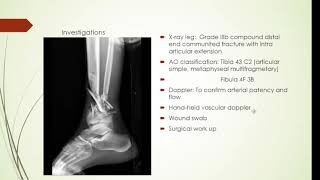 Plastiquest Case Discussion Lower Third Leg Defect [upl. by Saberio]