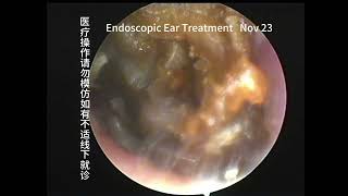 Reexamination of left ear cases not seen in a year 20231023 [upl. by Aelat]