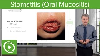 Stomatitis Oral Mucositis – Pediatric Infectious Diseases  Lecturio [upl. by Dniren]