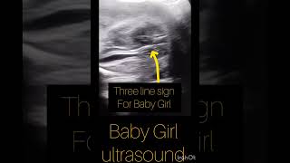 Gender reveal ultrasoundGirl ultrasound report100larki on ultrasoundyoutubeshortsviralshort [upl. by Lou]