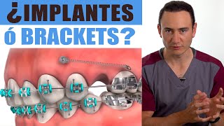 IMPLANTES o BRACKETS ¿Cuál va primero  ¡EL ORDEN SÍ IMPORTA  Ortodoncia vs Implantes [upl. by Gomer]