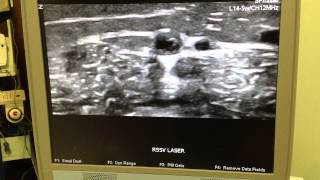 Incompetent Valve  Ultrasound Short Saphenous Vein IMG 0316 Scarless Vein Care by Dr Kamran [upl. by Enrev]