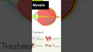 myopia optics [upl. by Hoyt]