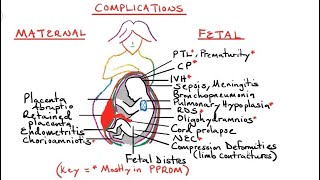 Premature Rupture Of Membrane  Midwifery and Obstetric Nursing Gnm Nursing Bsc Nursing [upl. by Irahc]