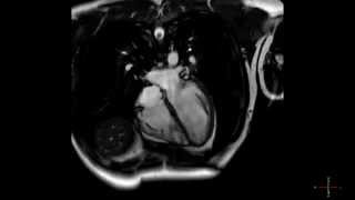 Cardiac MRI scan of a heart beating in high resolution  ECG gated CMRI in HD  real time scan [upl. by Euhsoj349]