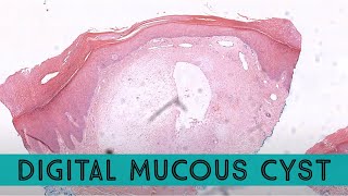 Digital mucous cyst Digital myxoid cyst similar to ganglion cyst pathology dermpath dermatology [upl. by Oakie629]