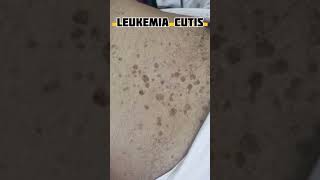 Chronic lymphocytic leukemia mrmc CLL leukimia pathology ⁴ [upl. by Newel904]