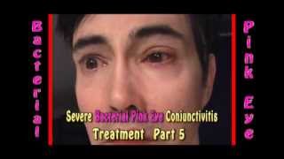 Severe Bacterial Pink Eye Conjunctivitis treatment part 5 [upl. by Ashien]