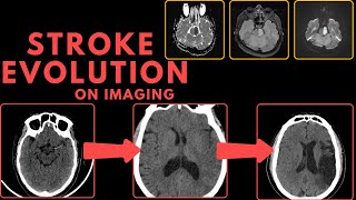 Stroke Evolution on CT and MRI Imaging [upl. by Badr419]