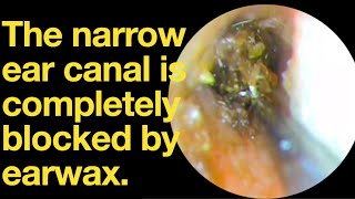 The narrow ear canal is completely blocked by earwaxear wax removal  ear cleaning  ASMR [upl. by Anette354]