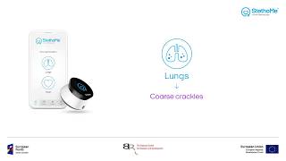 Lungs auscultation  coarse crackles 3 [upl. by Ynohtona]